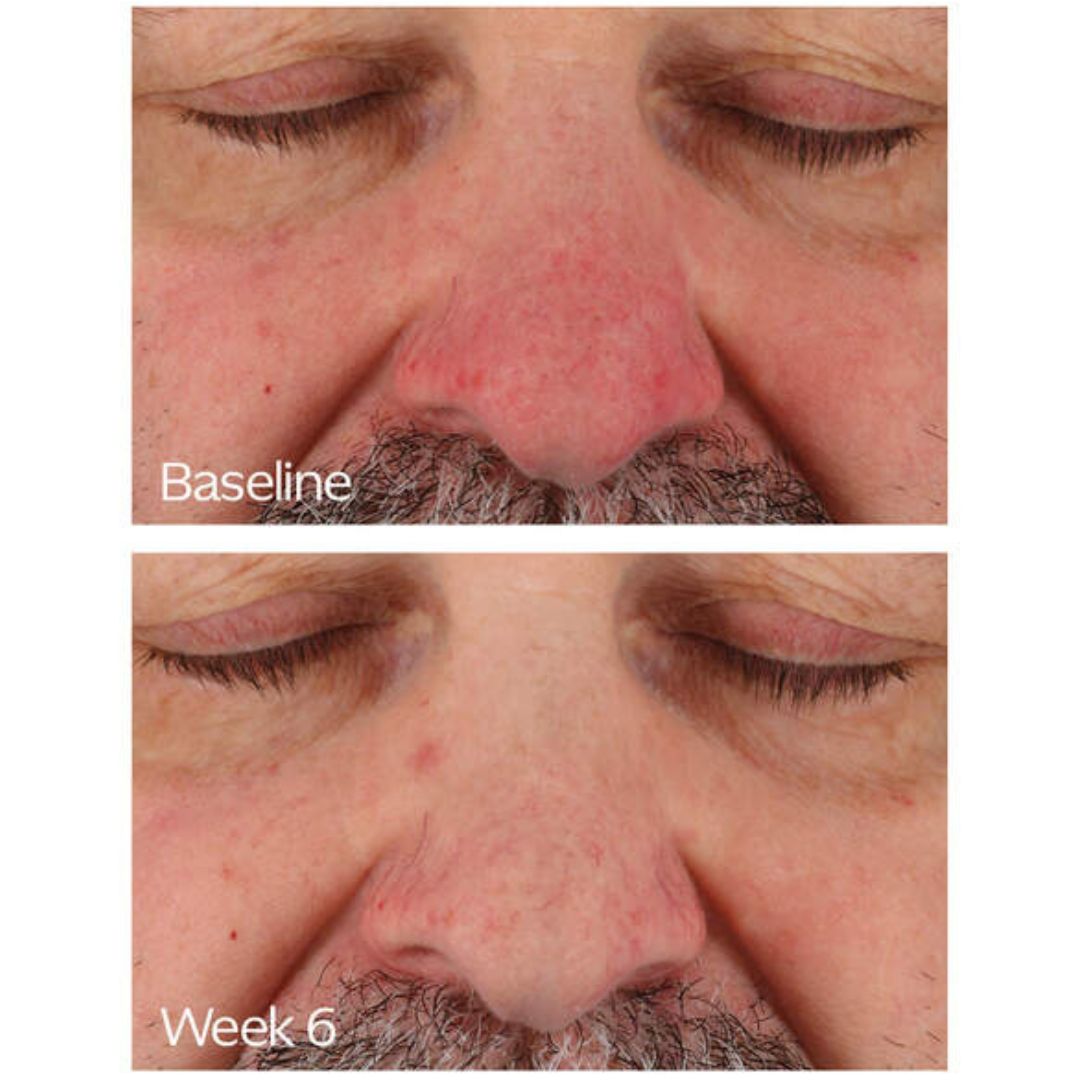 Rosacea Relief Skincare Bundle