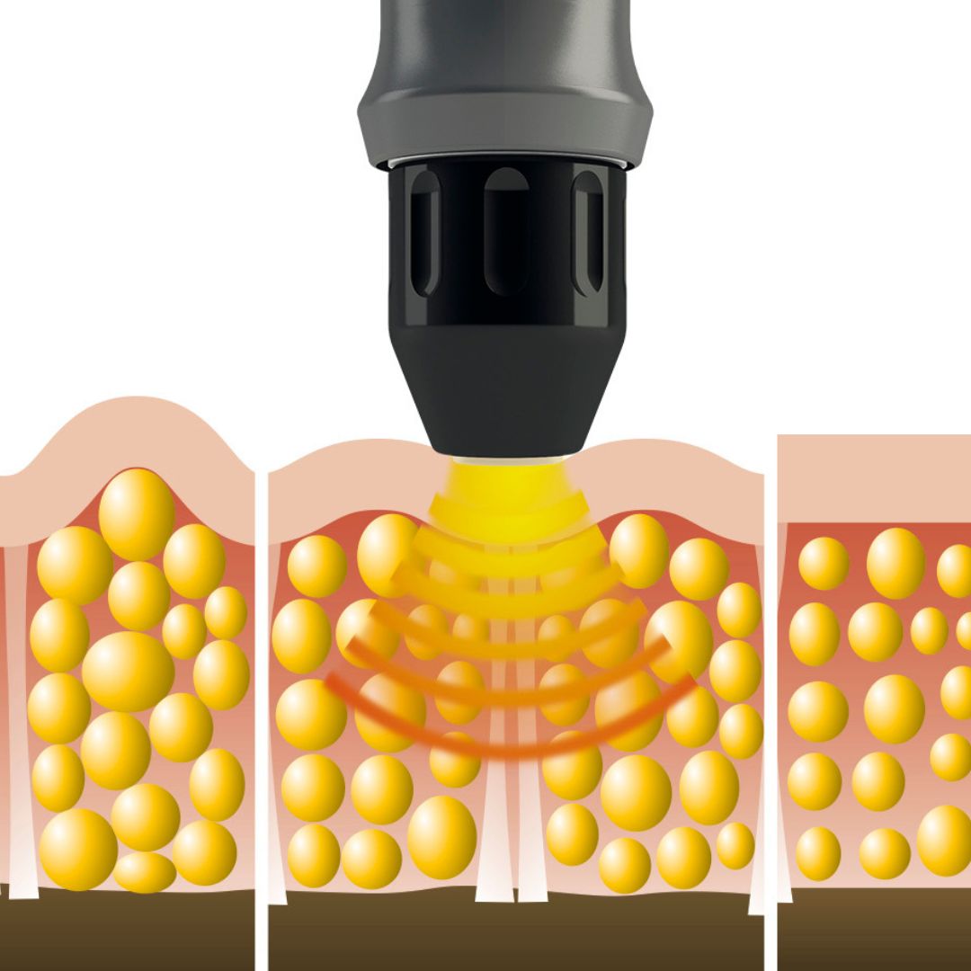 Shockwave Advanced Pain Relief (Post-Surgery)