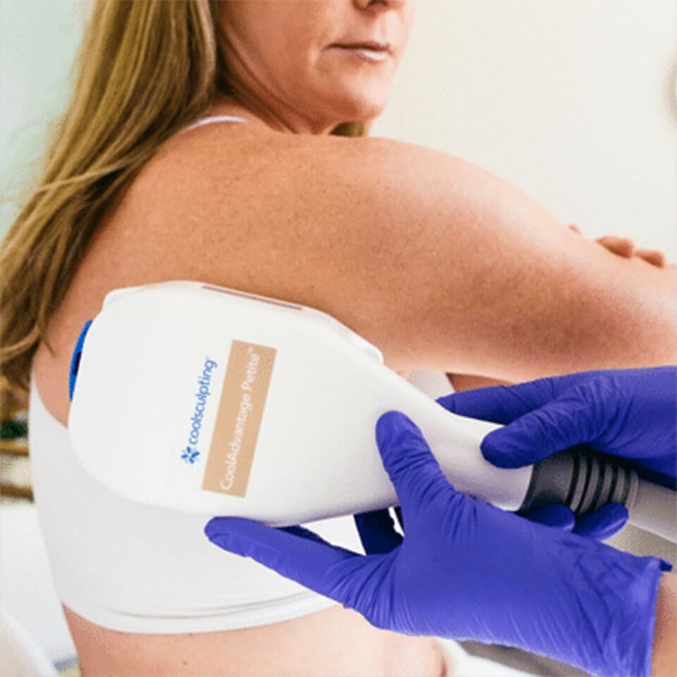 CoolSculpting® Bra Line