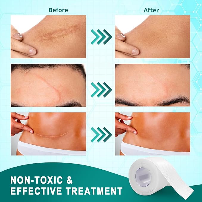 Silicone Scar Sheets for Surgical Scar