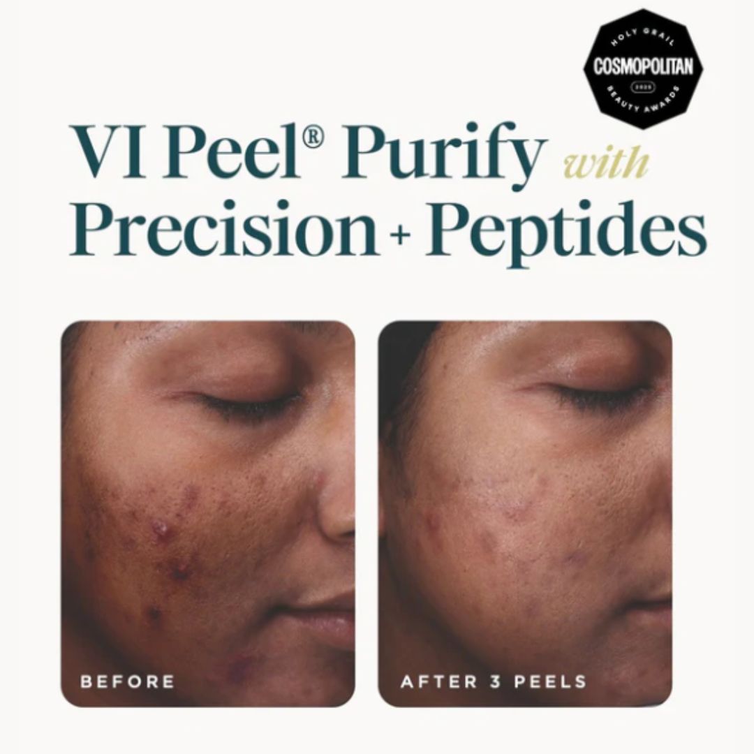 VI Peel