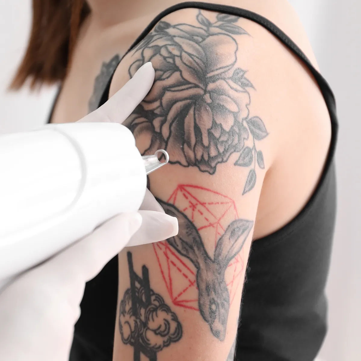 PicoWay Tattoo Removal