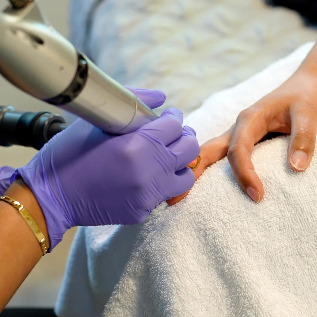 PicoWay Tattoo Removal