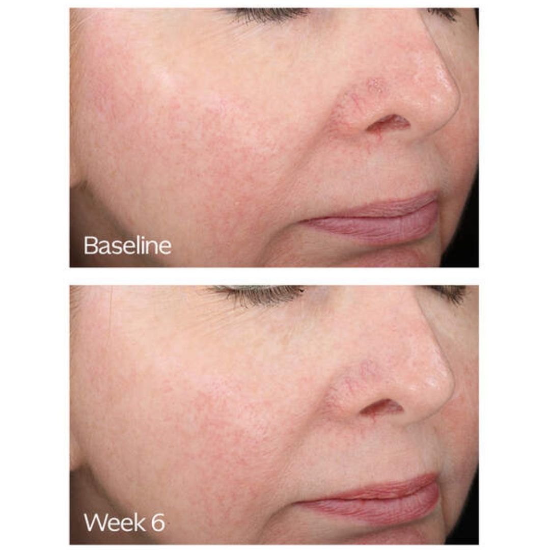 Rosacea Relief Skincare Bundle