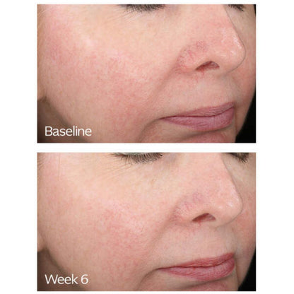 Rosacea Relief Skincare Bundle