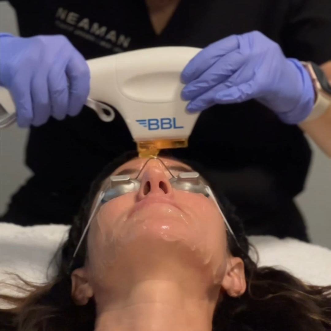 BroadBand Light (BBL™) Treatment