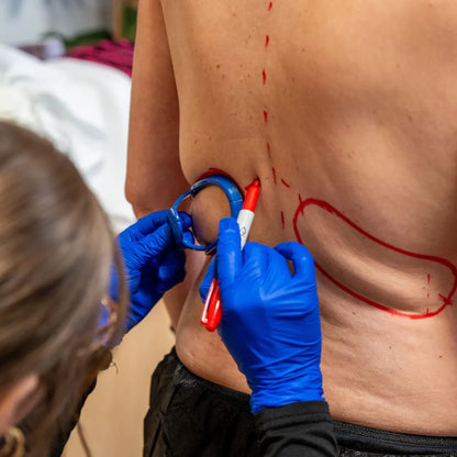 CoolSculpting® Elite