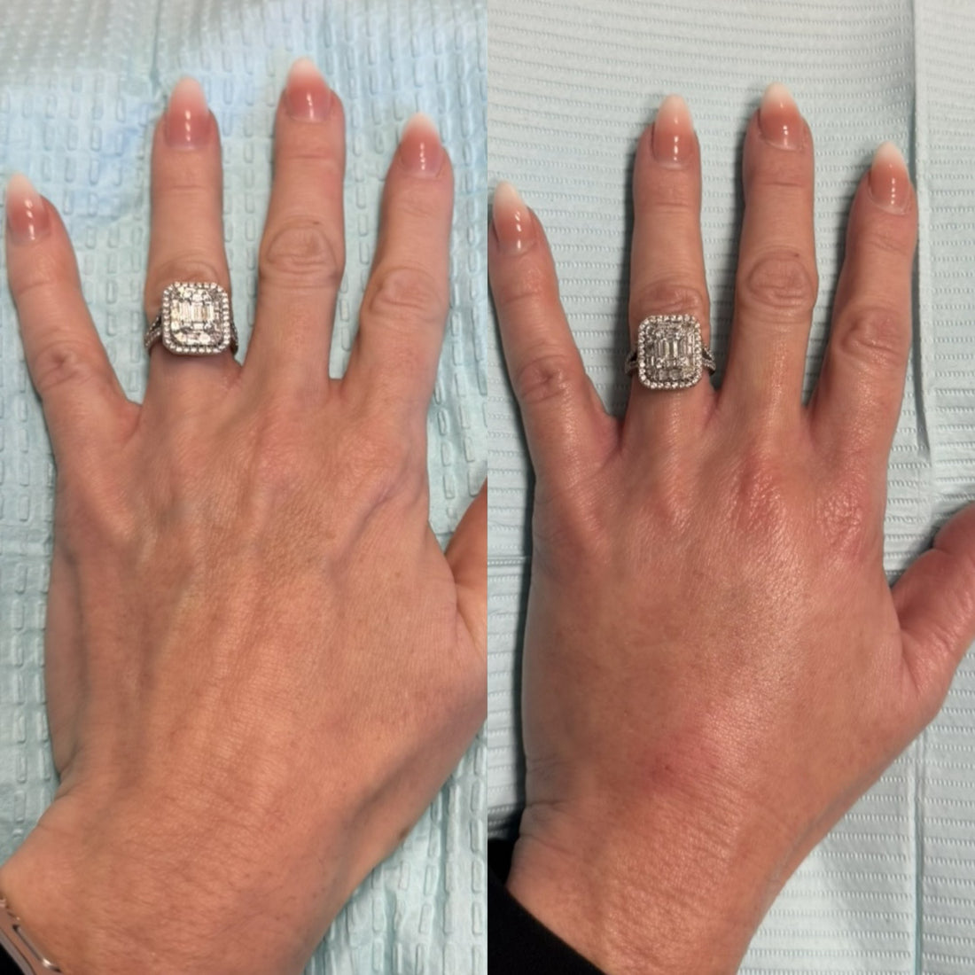 Dermal Filler Hand Rejuvenation