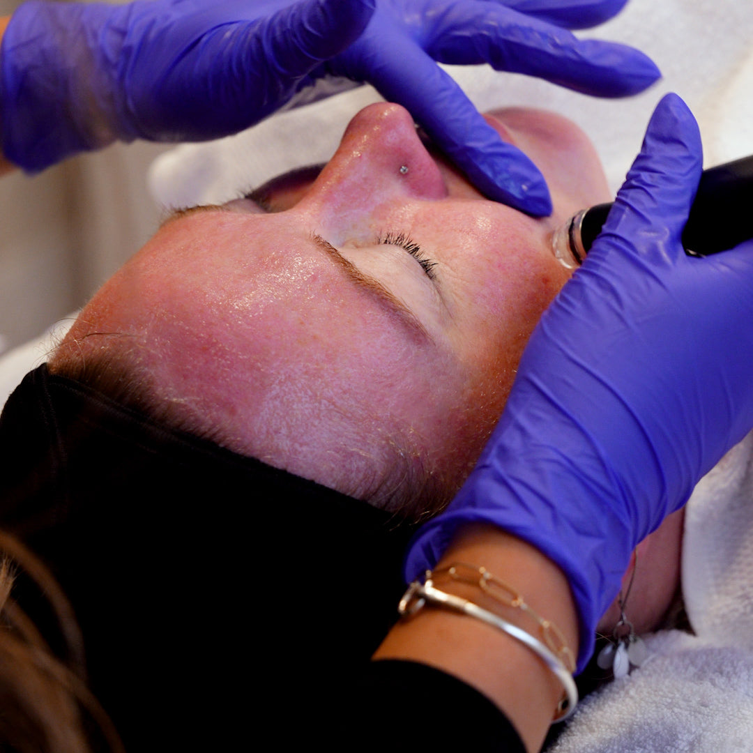 Hydrafacial