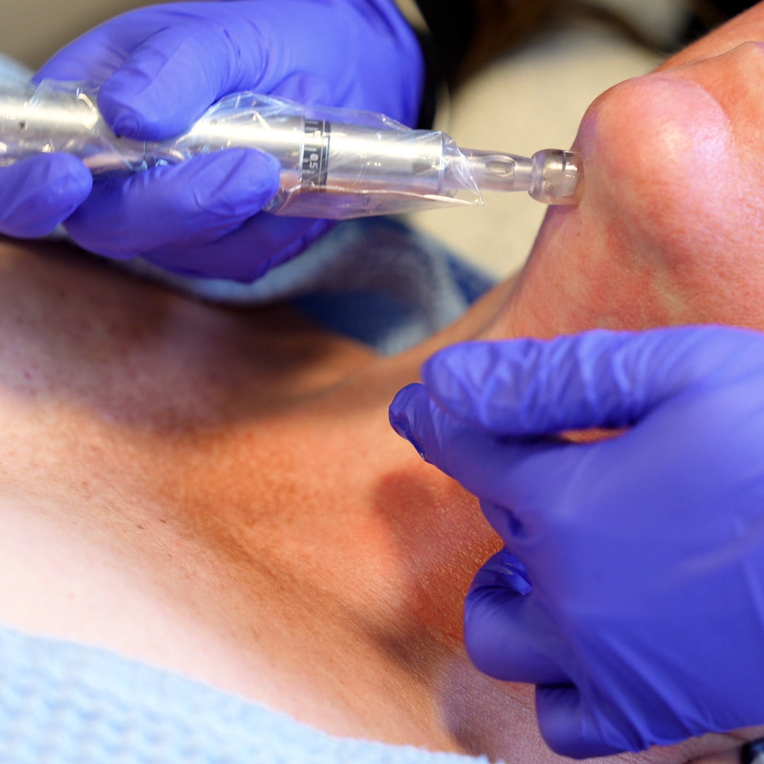 Exceed Microneedling