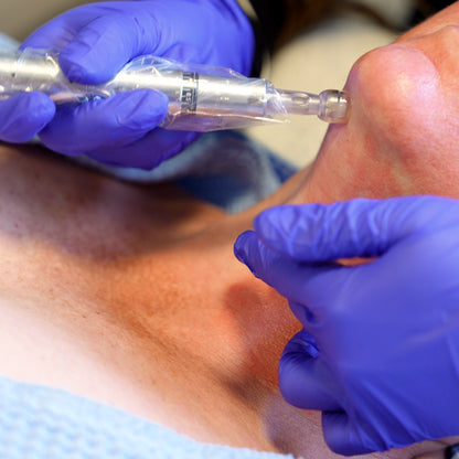 Exceed Microneedling