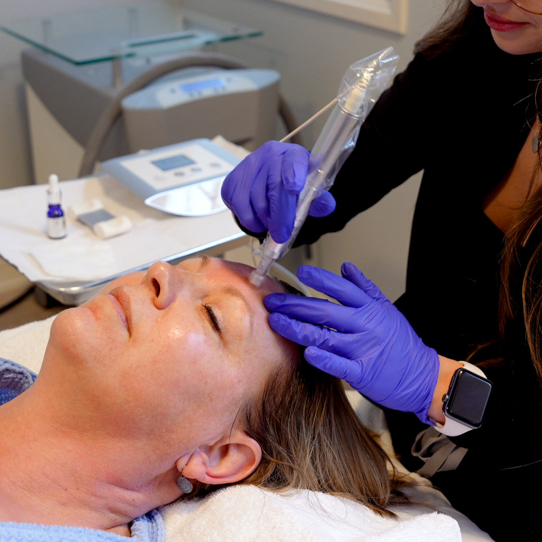 Exceed Microneedling