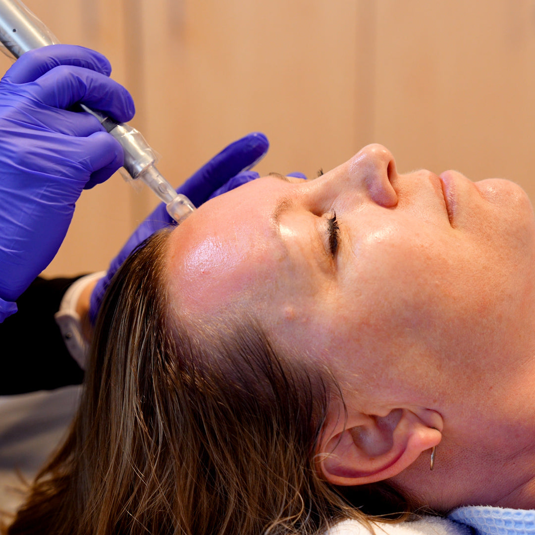 Exceed Microneedling