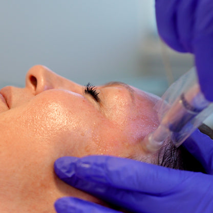 Exceed Microneedling