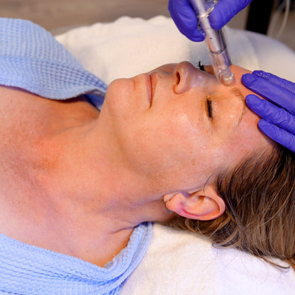 Exceed Microneedling