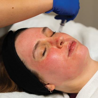 Exceed Microneedling