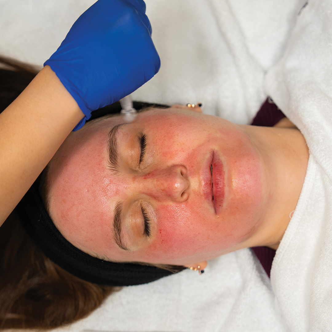 Exceed Microneedling
