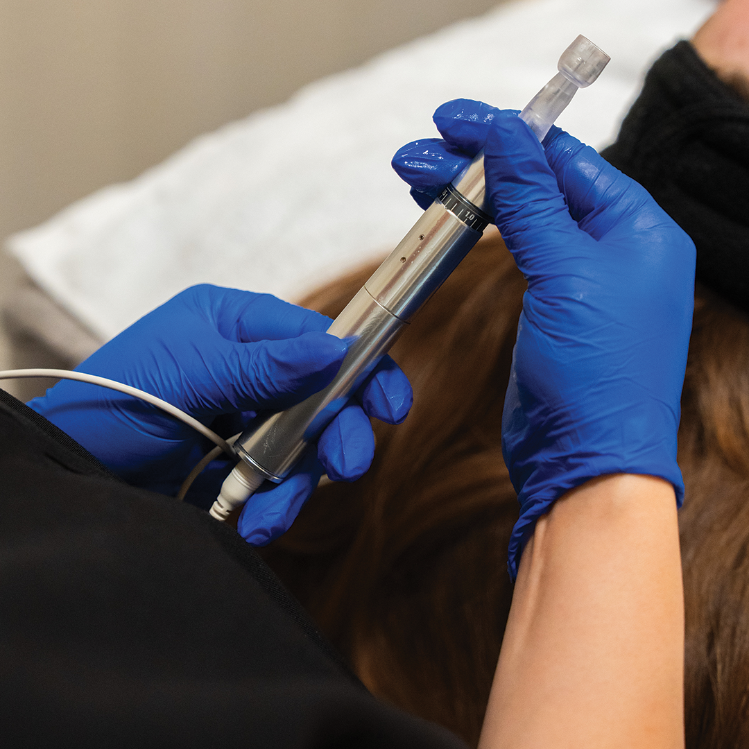 Exceed Microneedling