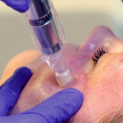 Exceed Microneedling
