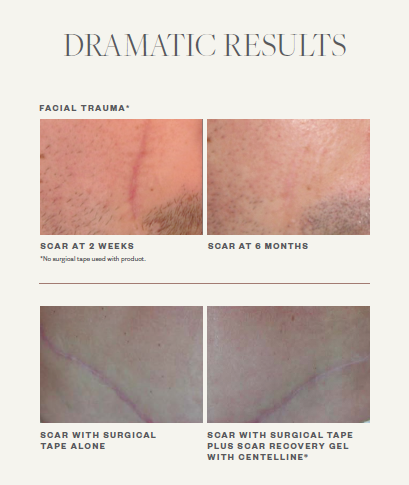 Scar Recovery Gel with Centelline®