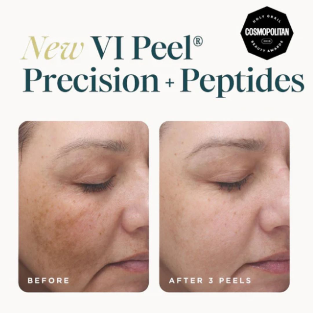 VI Peel