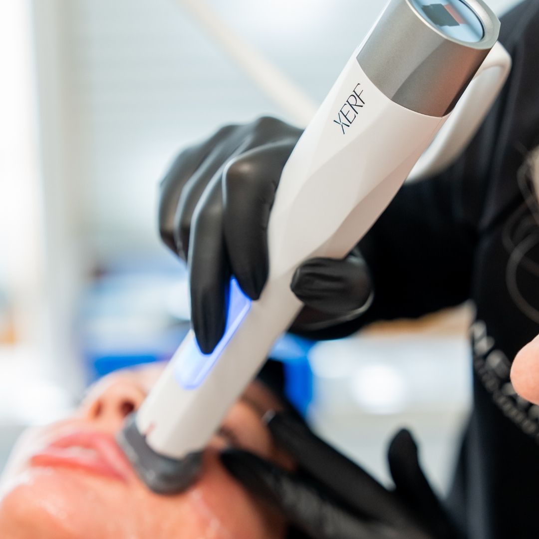 XERF Structural Skin Tightening