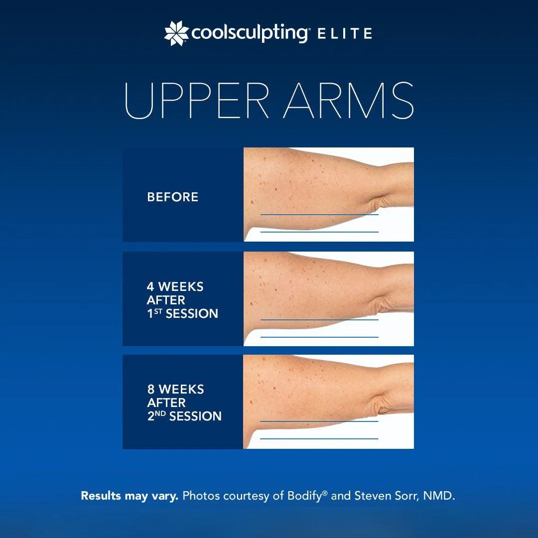 CoolSculpting® Elite