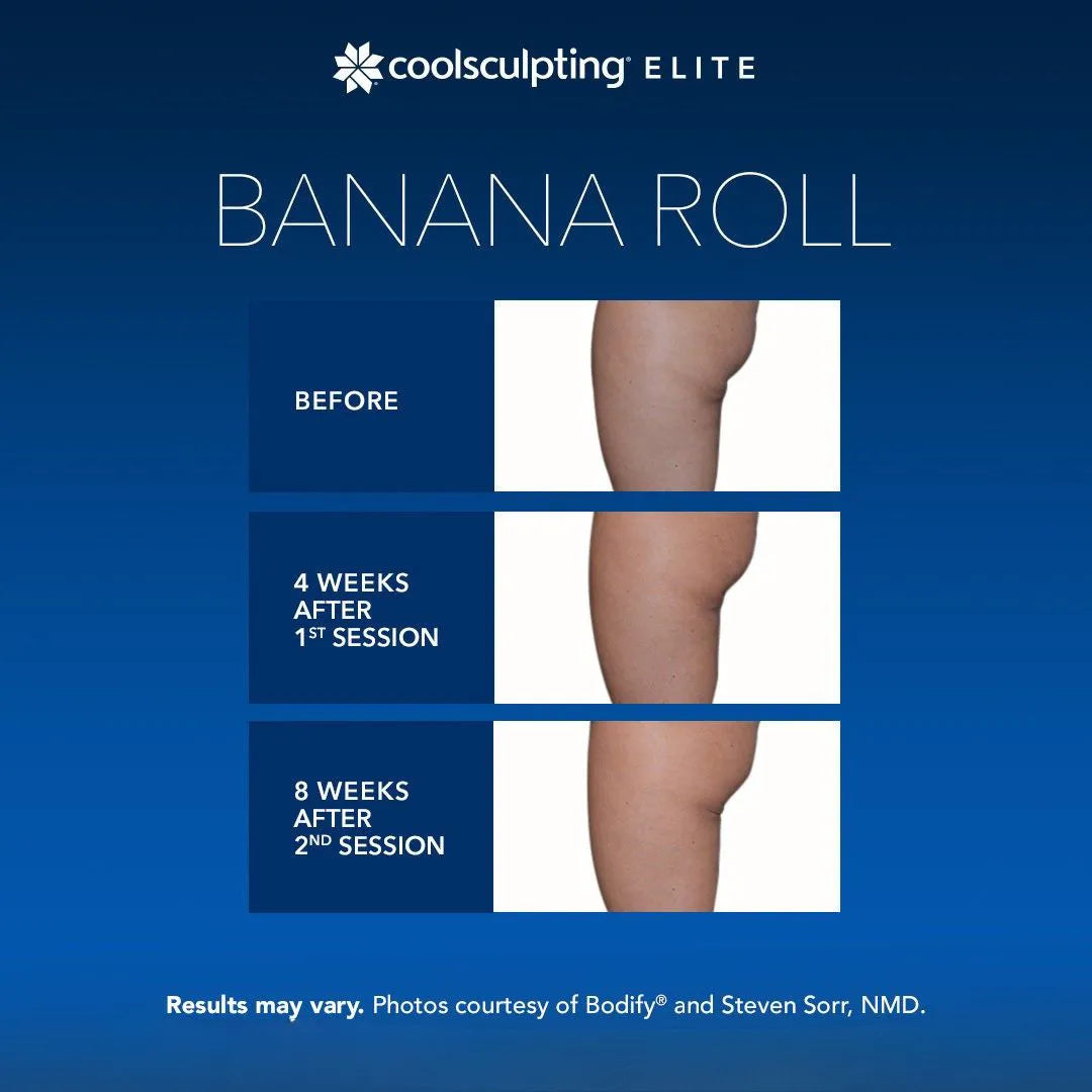 CoolSculpting® Elite