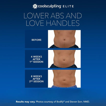 CoolSculpting® Elite