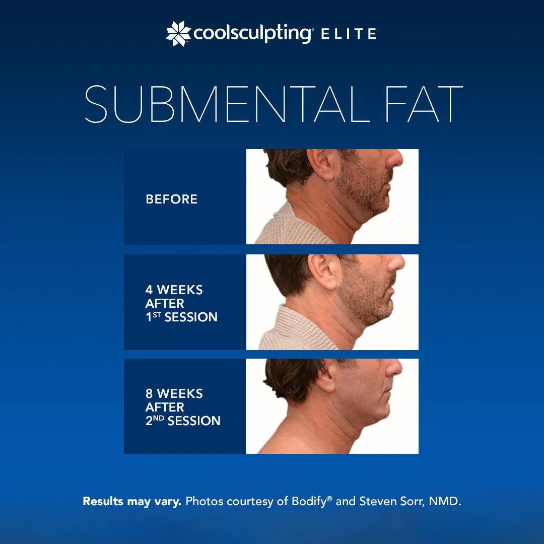 CoolSculpting® Elite
