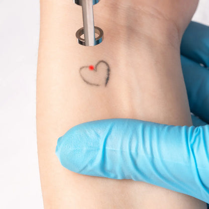 PicoWay Tattoo Removal