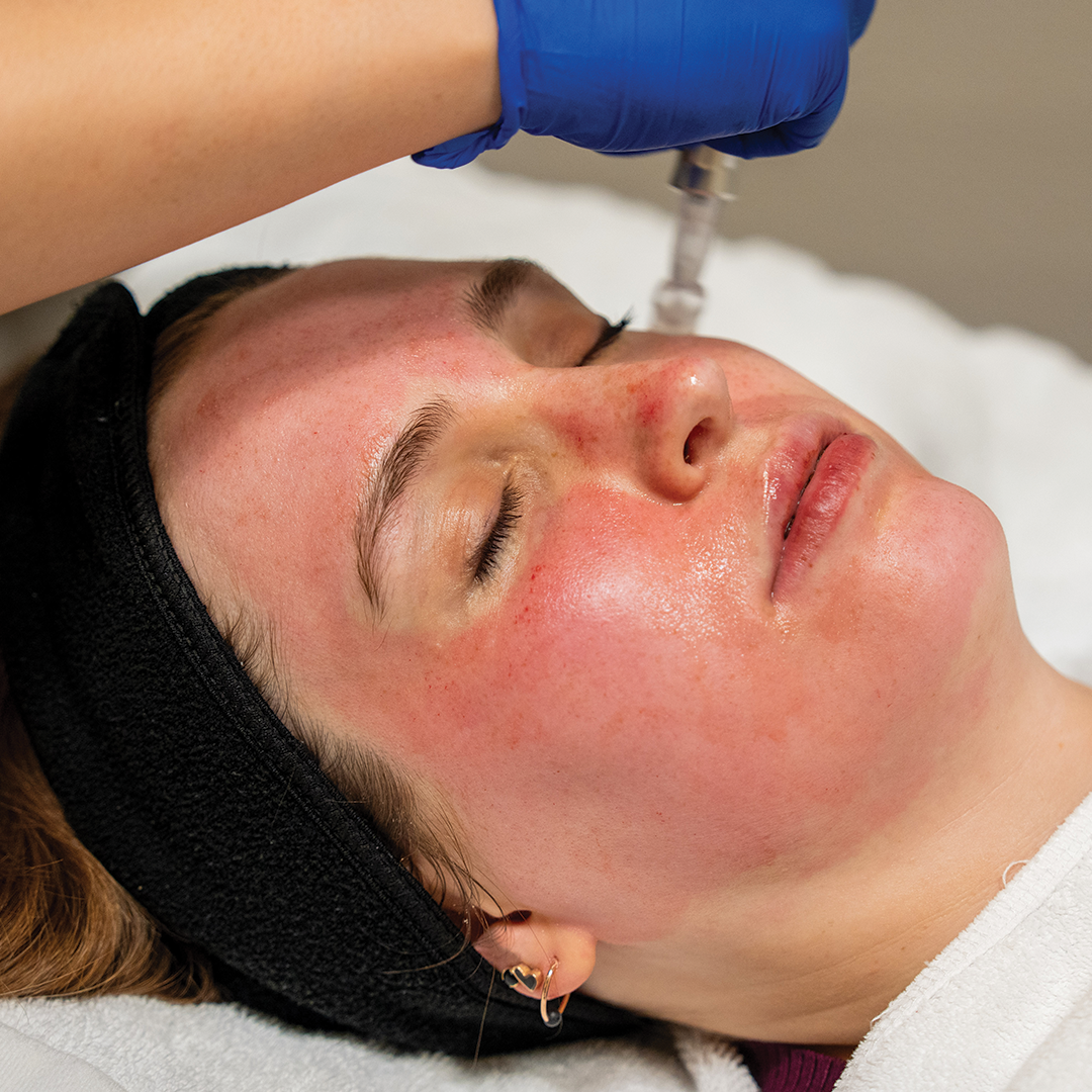 Exceed™ Microneedling