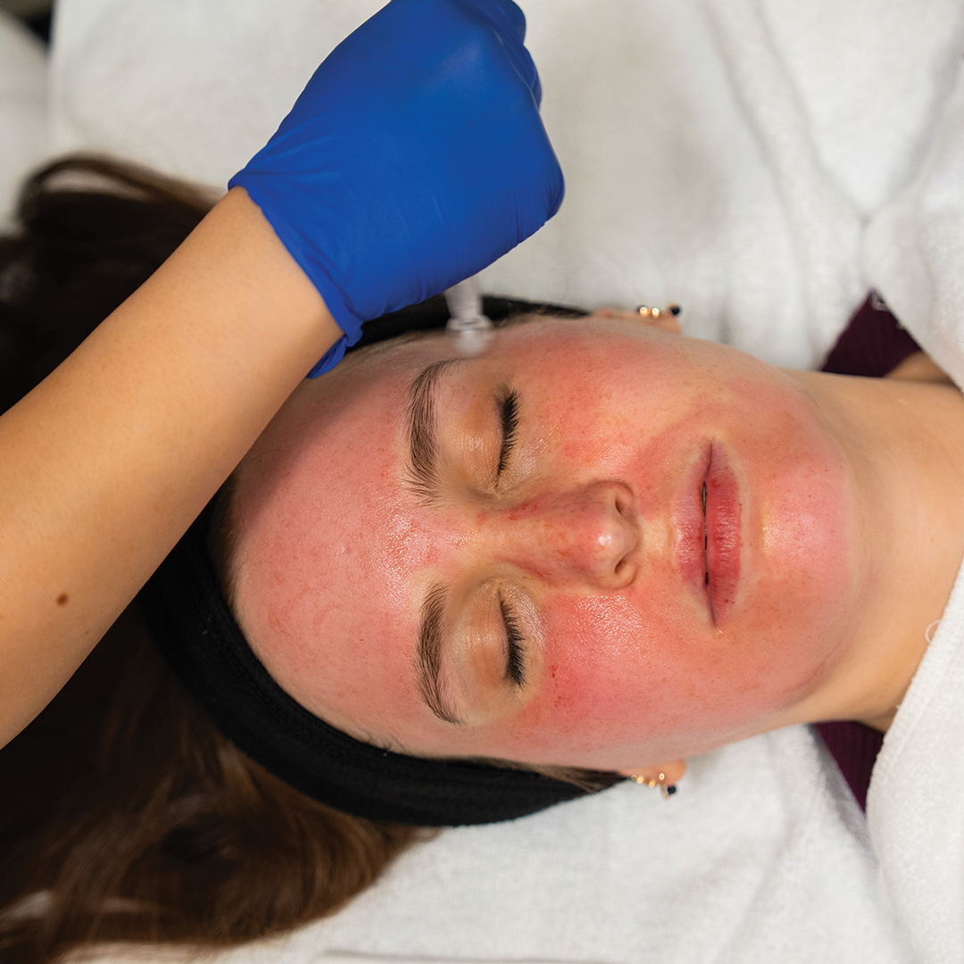 Exceed Microneedling