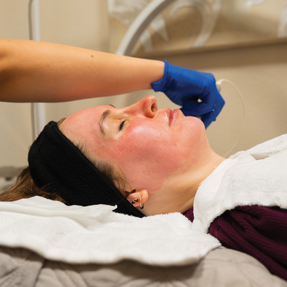 Exceed Microneedling