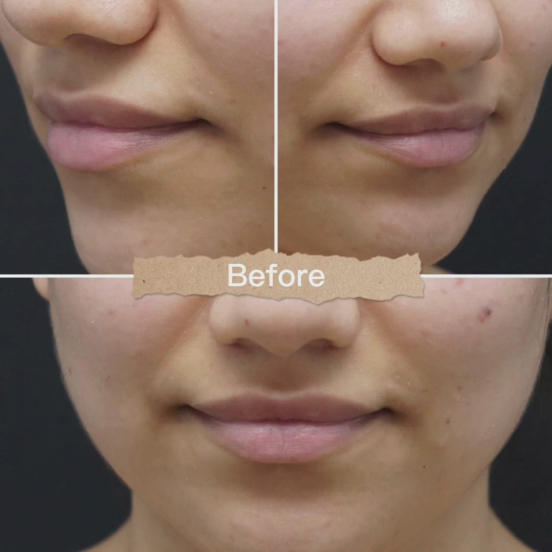 Dermal Filler