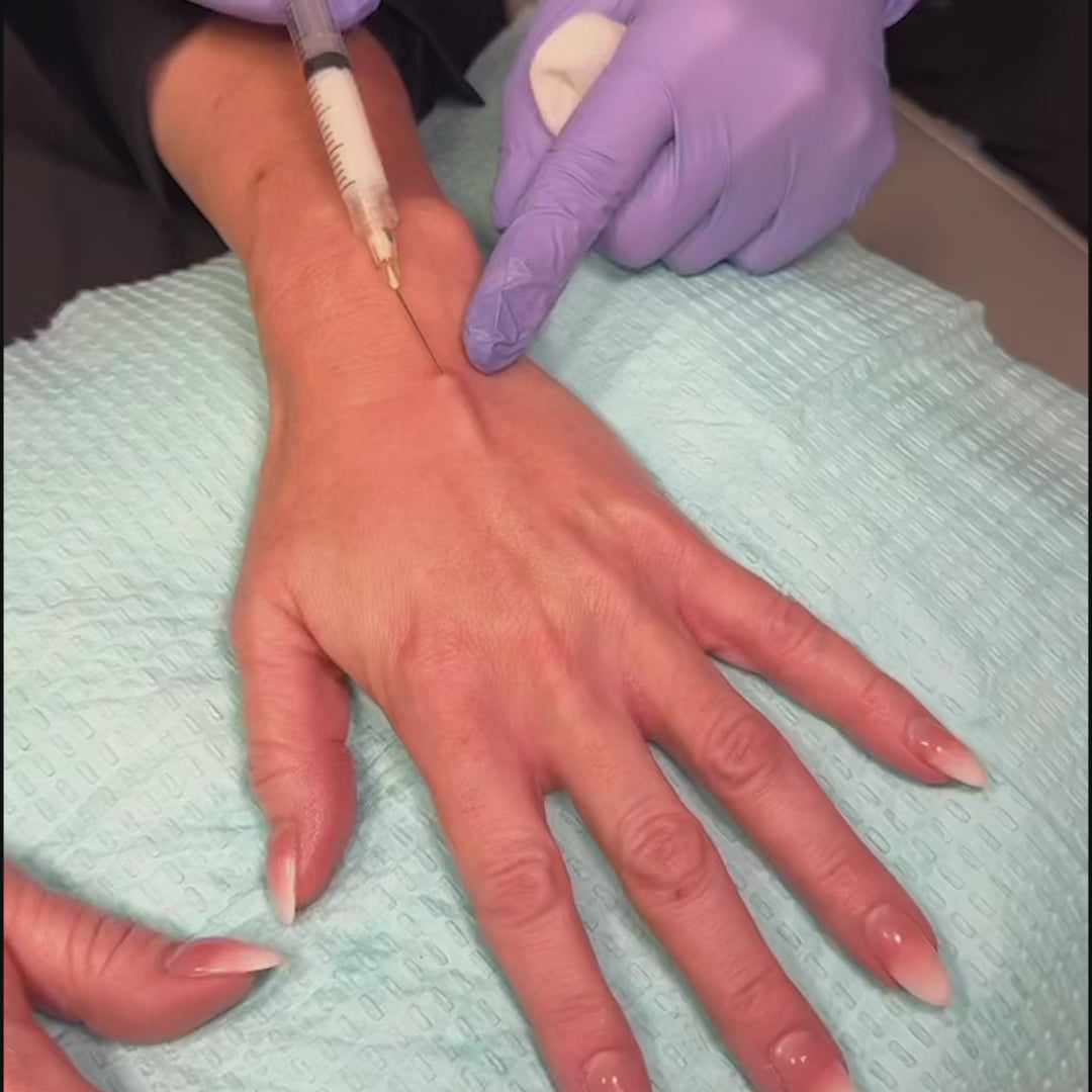 Dermal Filler Hand Rejuvenation