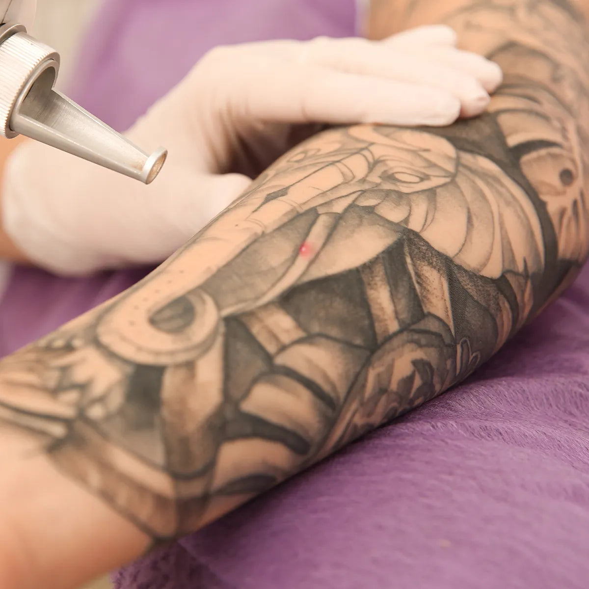PicoWay Tattoo Removal