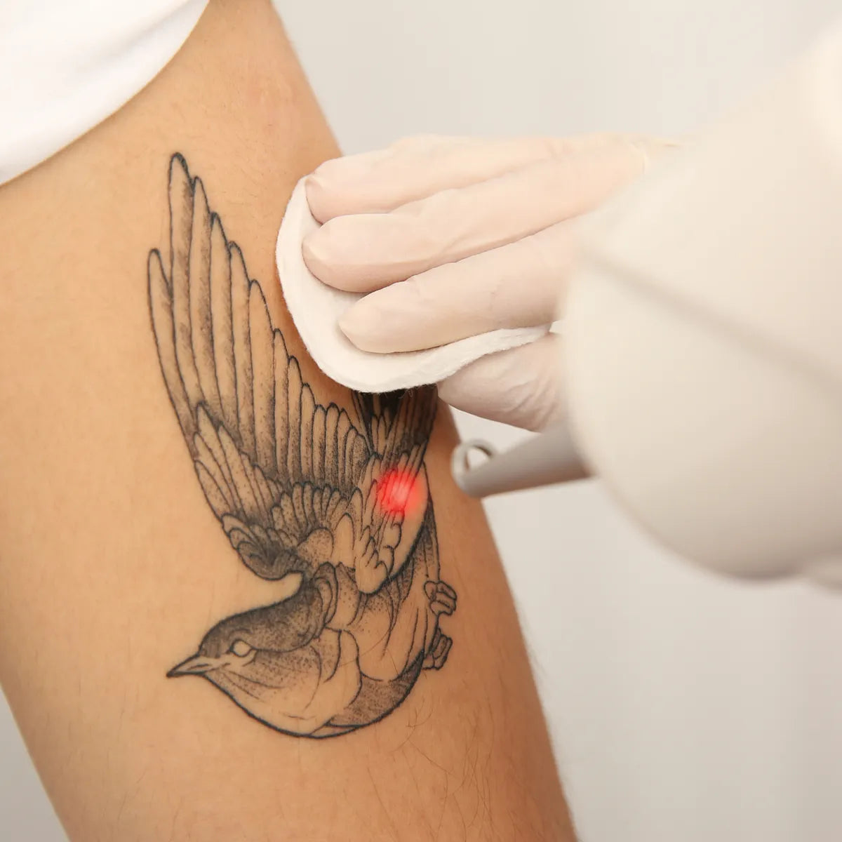 PicoWay Tattoo Removal