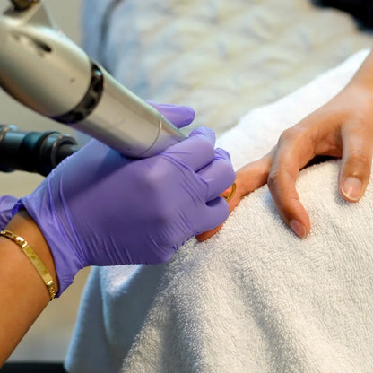 PicoWay Tattoo Removal