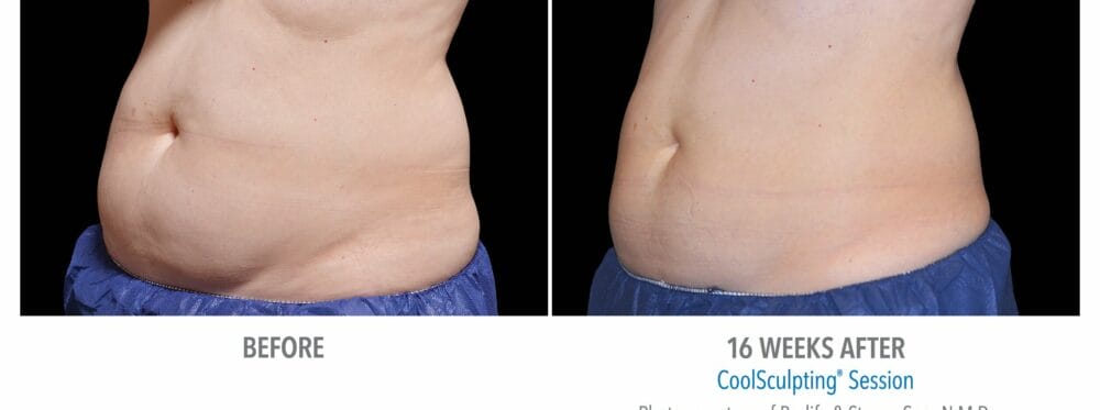 coolsculpting patient 4 flanks view