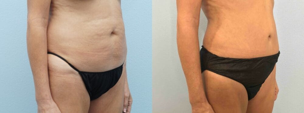 Abdominoplasty Patient 39 left angle view