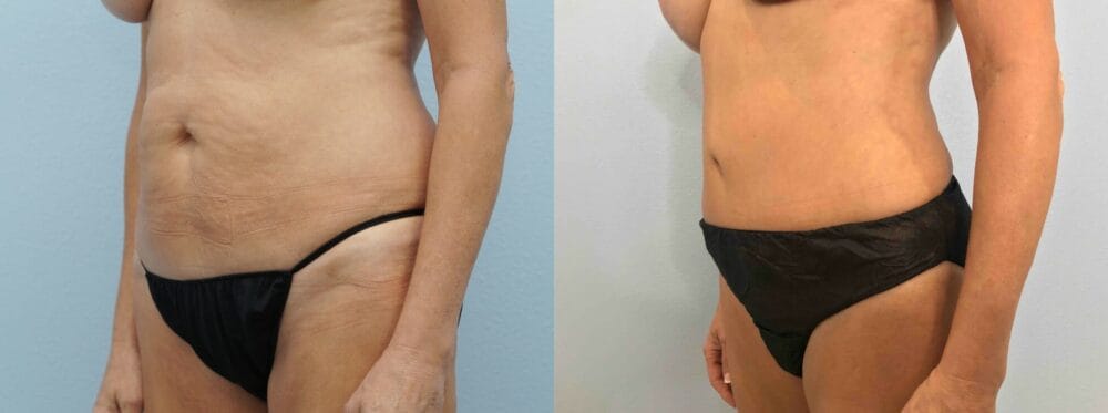 Abdominoplasty Patient 39 right angle view