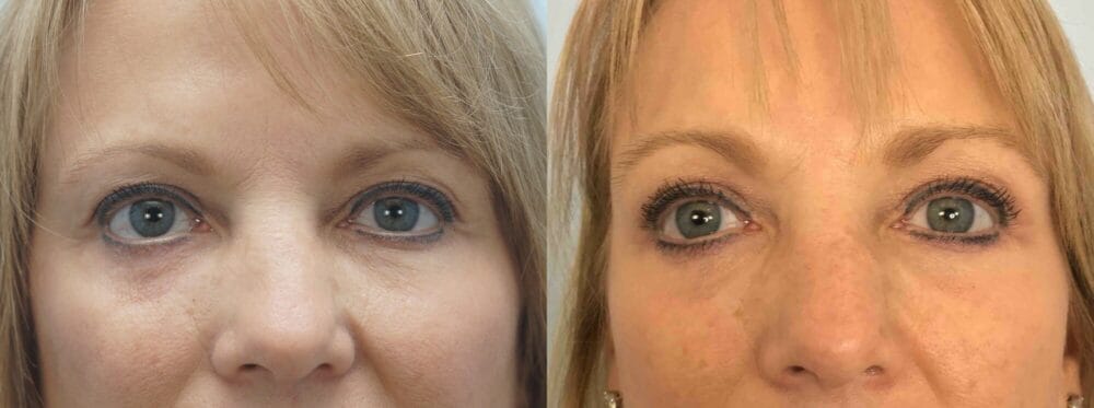EYELID SURGERY (BLEPHAROPLASTY) PATIENT 16 front view