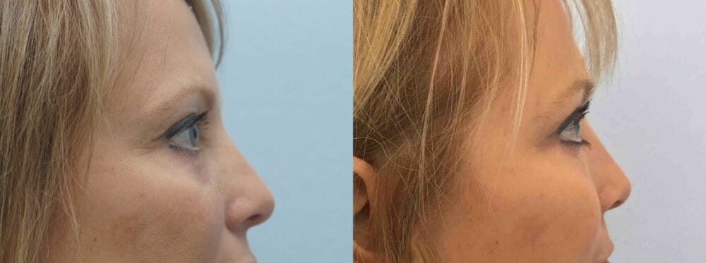 EYELID SURGERY (BLEPHAROPLASTY) PATIENT 16 left view
