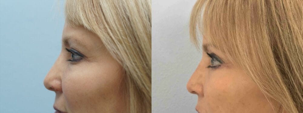 EYELID SURGERY (BLEPHAROPLASTY) PATIENT 16 right view