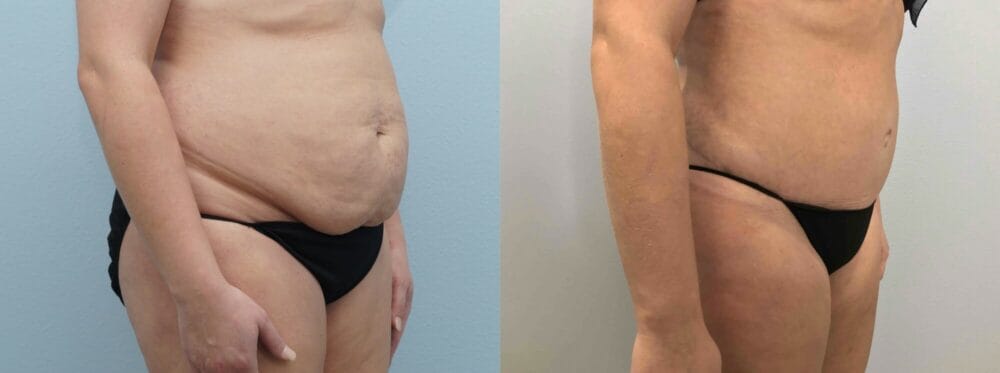 Abdominoplasty (Tummy Tuck) patient 42 left angle view