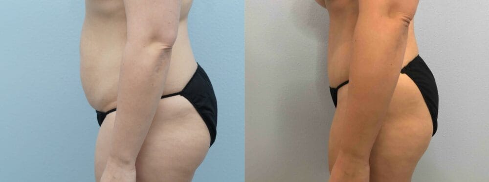 abdominoplasty patient 38 right angle view
