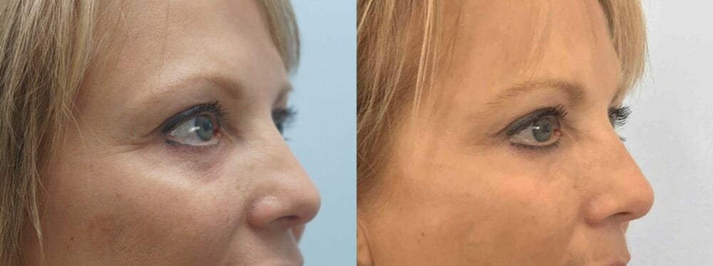 EYELID SURGERY (BLEPHAROPLASTY) PATIENT 16 left angle view