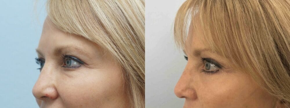 EYELID SURGERY (BLEPHAROPLASTY) PATIENT 16 right angle view