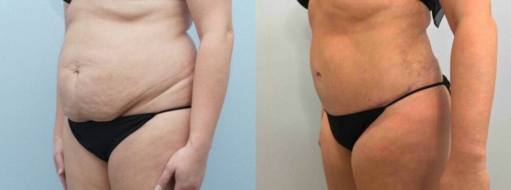 TUMMY TUCK (ABDOMINOPLASTY) PATIENT 42 right angle view
